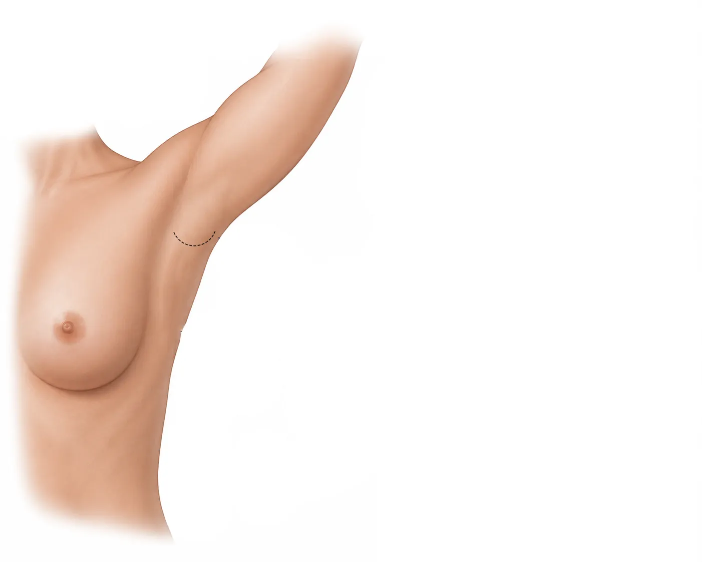 incisão na axila cirurgia de esvaziamento axilar